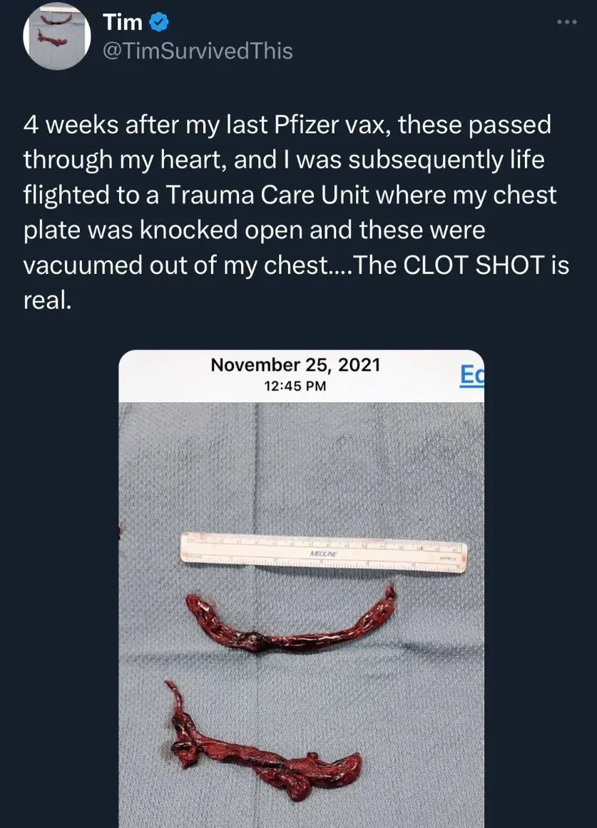 @TimSurvivedThis - clots passed through heart 4 weeks after Pfizer, emergency surgery