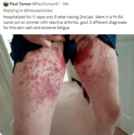 Paul Turner @PaulTurner47 tweet - Hospitalized 11 days only 9 after 2nd jab, went in fit 64, came out on zimmer with reactive arthritis, gout, 3 diagnoses for skin rash and extreme fatigue. Photo of severe rash on legs