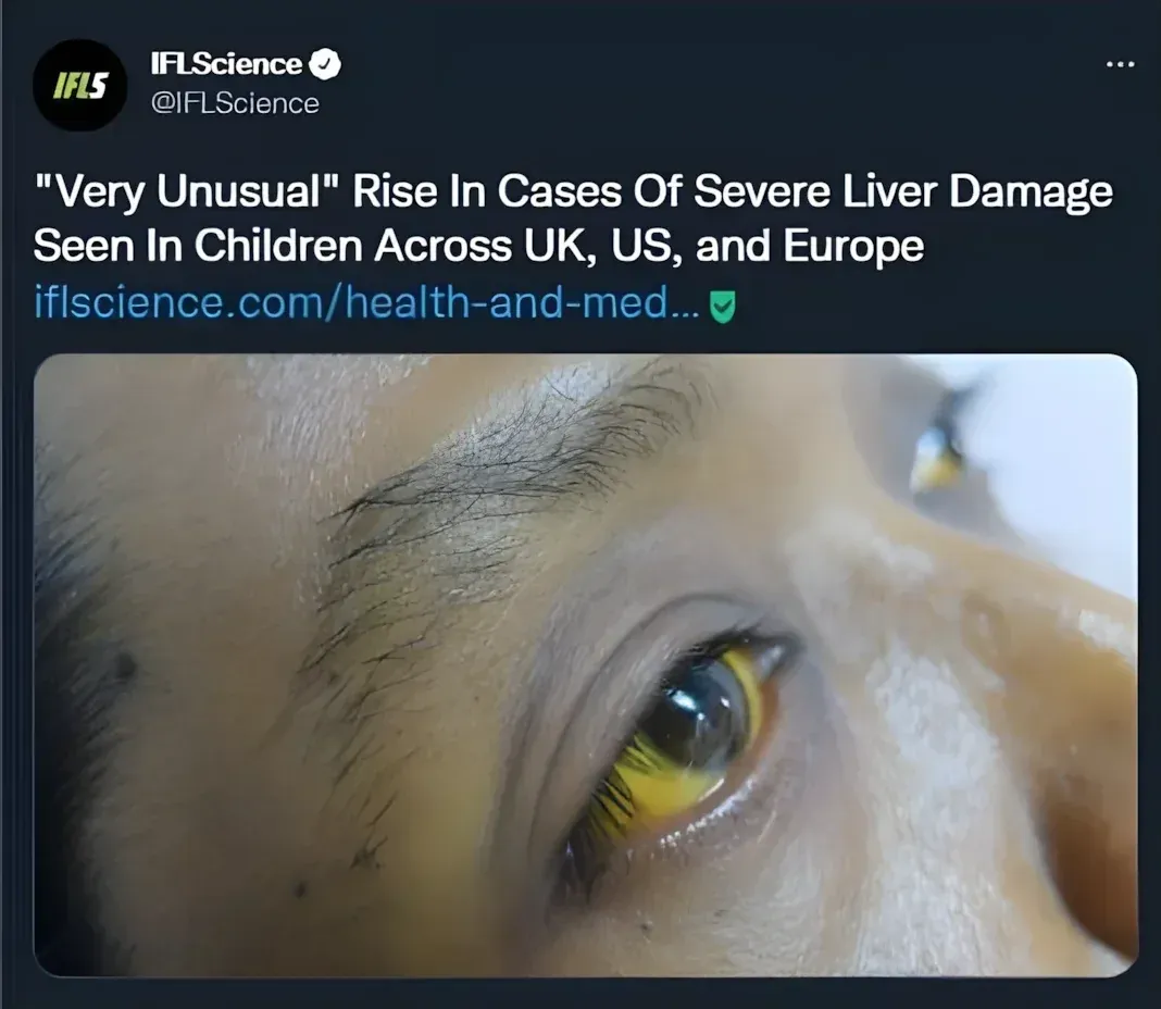 IFLScience @IFLScience tweet - Very Unusual Rise In Cases Of Severe Liver Damage Seen In Children Across UK, US, and Europe. Close-up photo of child with jaundiced yellow eyes